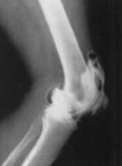 Рентгенограмма коленного сустава в боковой проекции.