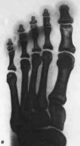 Рентгенограмма стопы - прямая подошвенная проекция.