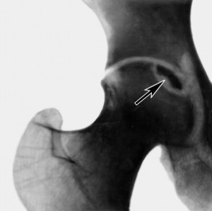 Пример рентгенограммы тазобедренного сустава.