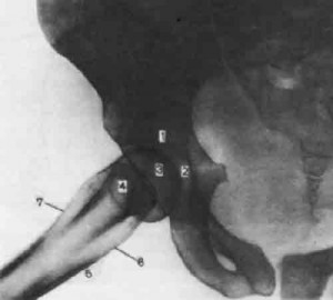 Укладка при выполнении рентгенограммы тазобедренного сустава.