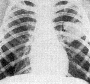 Рентгенограмма в прямой проекции трахея.
